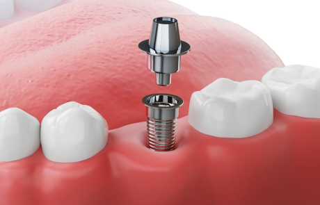 Dental titanium